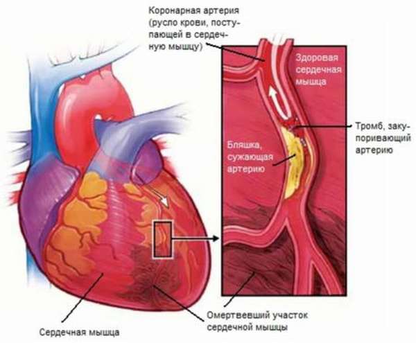 Как изменяются показатели температуры при разных формах инфаркта?