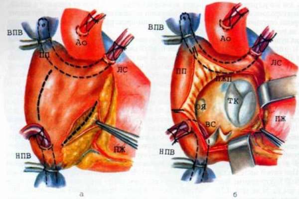 Причины учащенного сердцебиения при нормальном артериальном давлении