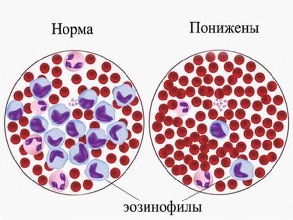 Чем вызывается появление незрелых гранулоцитов в крови человека?