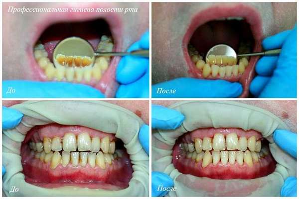 Причины возникновения флюса зуба