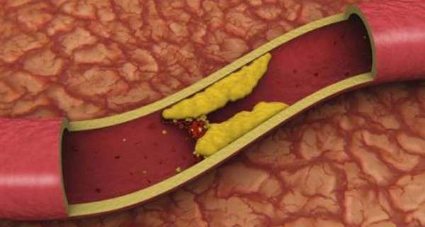 Причины развития и ранние симптомы височного артериита