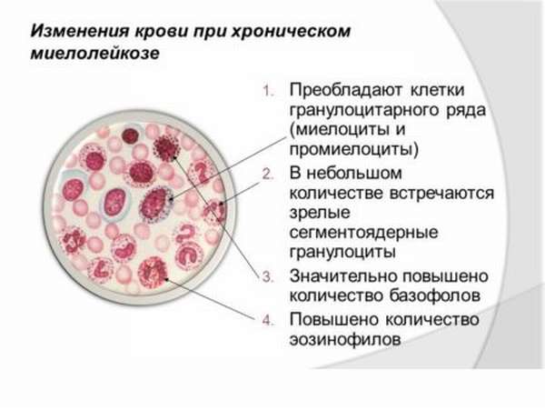 Какие причины вызывают появление миелоцитов в анализе крови человека?