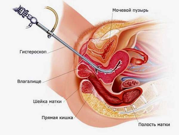 Лечение миомы матки - гетероскопия