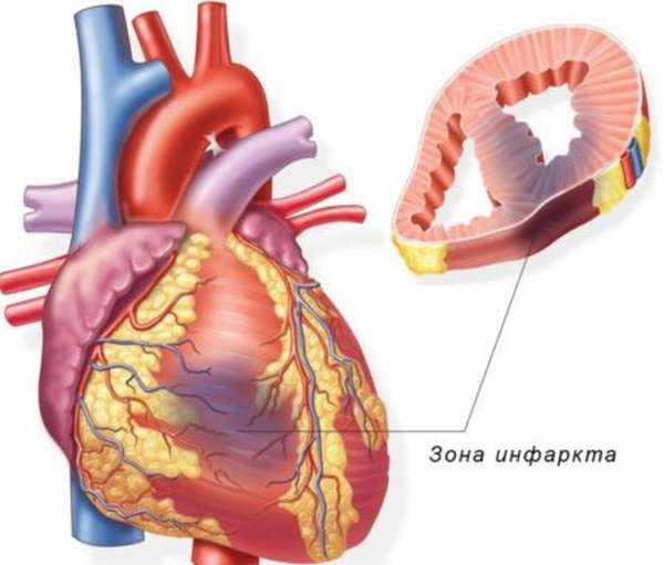 Боль в сердце, тошнота и кружится голова: похожие симптомы различных патологий