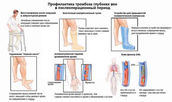 Диагностика тромбоза вен нижних конечностей: симптомы, патологическая диагностика и лечение