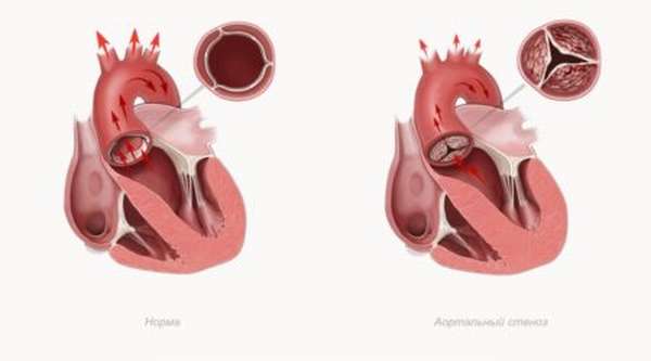 Причины, вызывающие врожденный порок сердца у детей, симптомы и методы лечения
