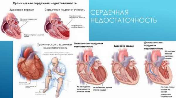 Симптомы сердечной недостаточности острого и хронического типа