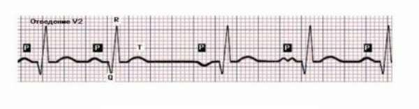 Как расшифровать на ЭКГ признаки нарушения ритма сердцебиения