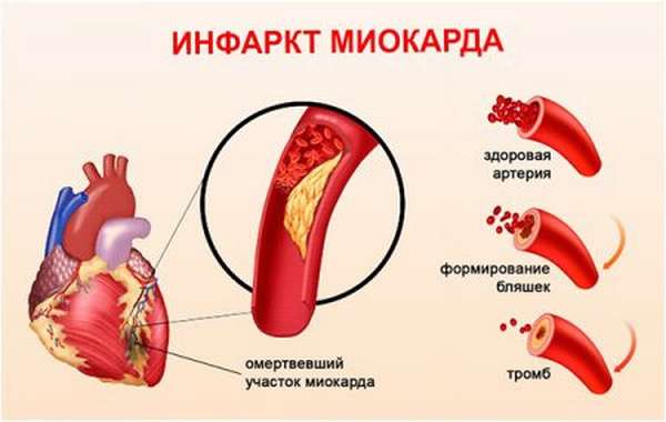 Опасность острого инфаркта миокарда, виды приступа, симптоматика, организация эффективной терапии