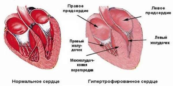 Причины увеличенного сердца у взрослого человека, симптомы и диагностические меры