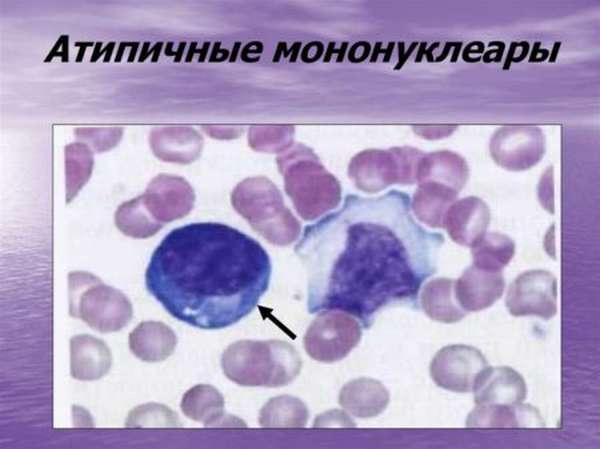 Атипичные мононуклеары в общем анализе крови когда они появляются thumbnail