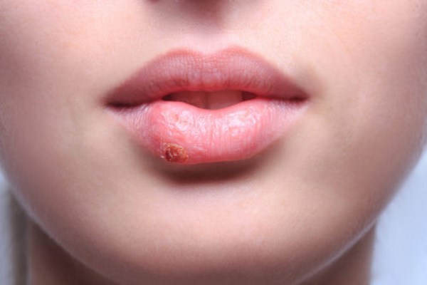 Противопоказания по увеличению губ герпес