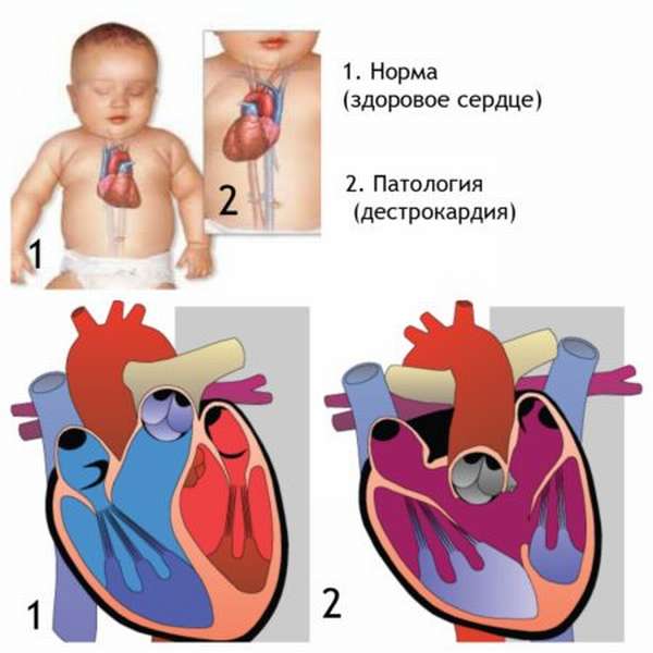 Как ЭКГ при декстрокардии сердца помогает достоверно определить эту патологию