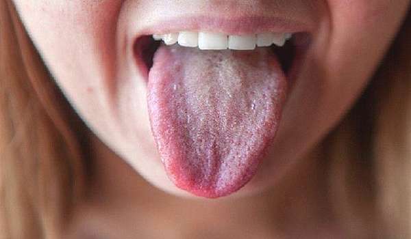 Белый налет на языке, причины, лечение у взрослых