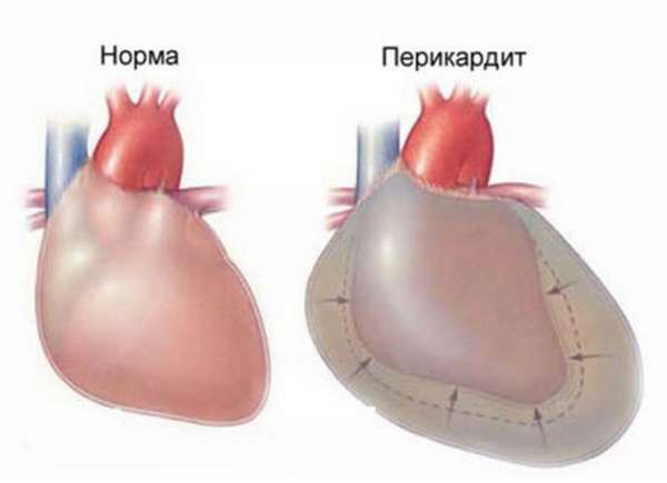 Как проявляется боль в сердце? Определяющие признаки и отличительные особенности