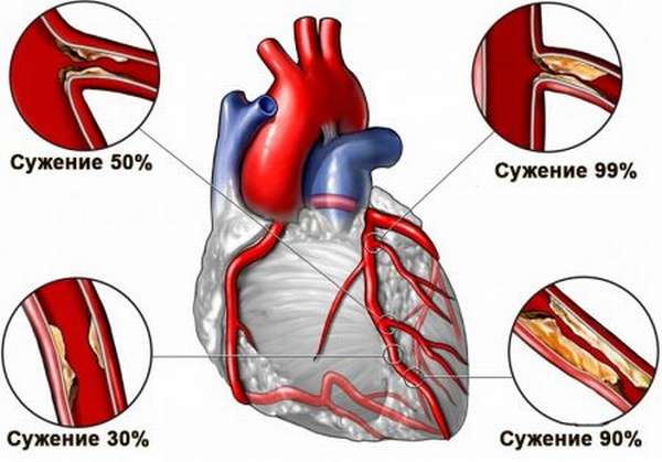 Какие симптомы и последствия рубца на сердце, появившегося после инфаркта