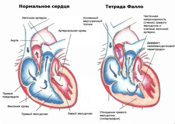 Особенности проявления атрезии легочной артерии и причины ее возникновения, прогноз и профилактика