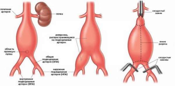 Какие симптомы наблюдаются при аневризме бедренной артерии? Насколько опасна эта болезнь?
