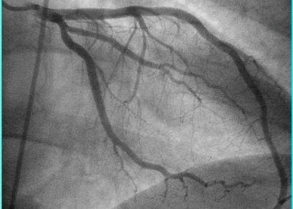 Последствия коронарографии сосудов сердца, методы исследования и возможные осложнения