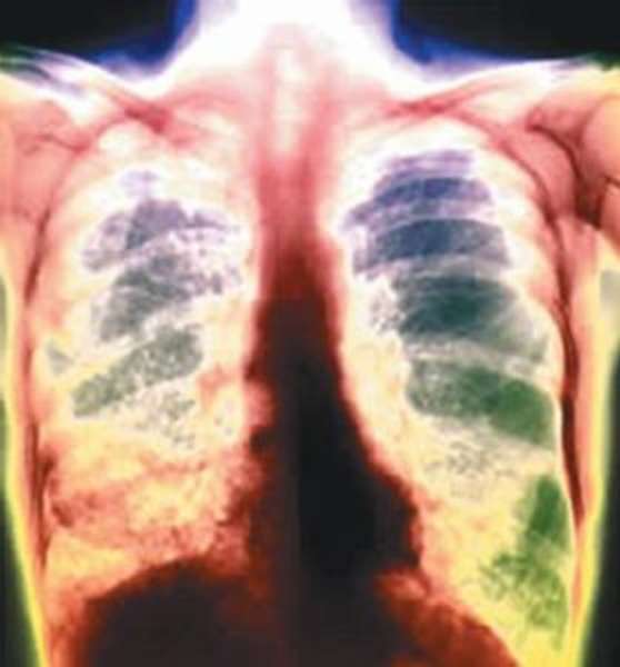 Болезьнь туберкулёз очень опасна