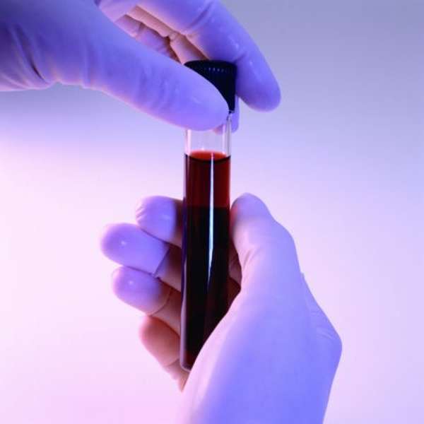 Lym в анализе крови что это такое расшифровка thumbnail