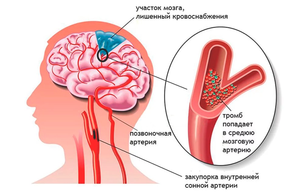 Хроническая ишемия головного мозга: диагностика, лечение