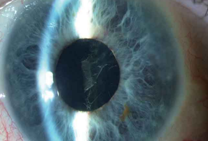 Вторичная катаракта – что это?
